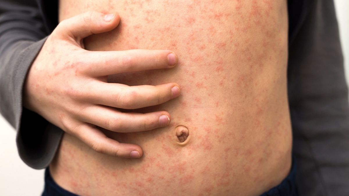 Measles in Europe: Where are cases of one of the world’s most contagious diseases on the rise?