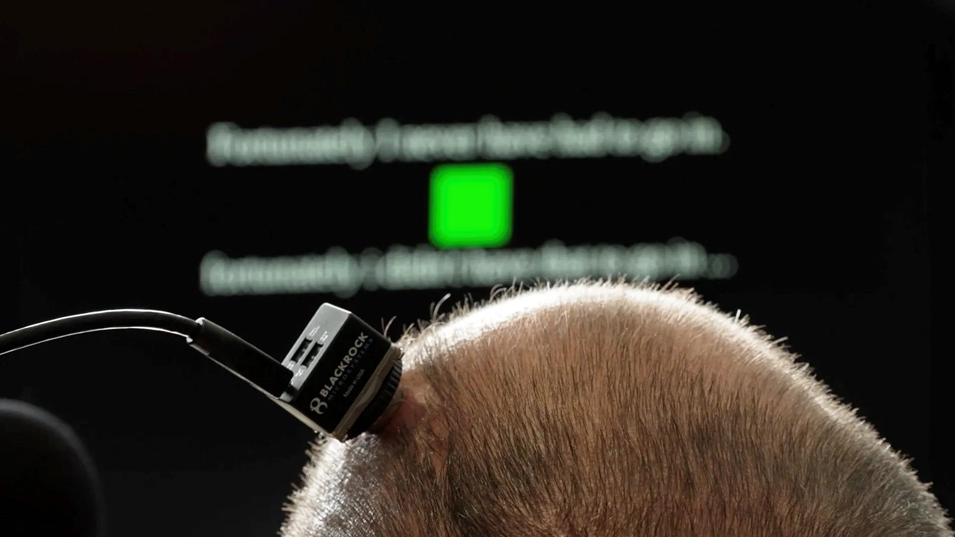 Brain-computer interface restores real-time speech in als patient