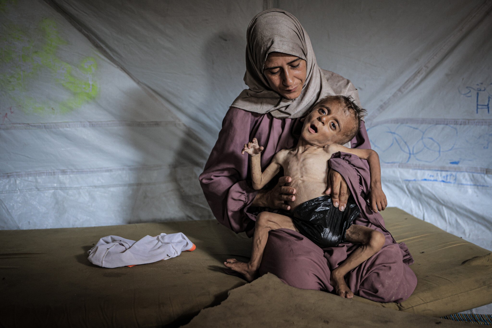 ‘We never see kids like this:’ Israeli doctors speak out on emaciated Gazan children