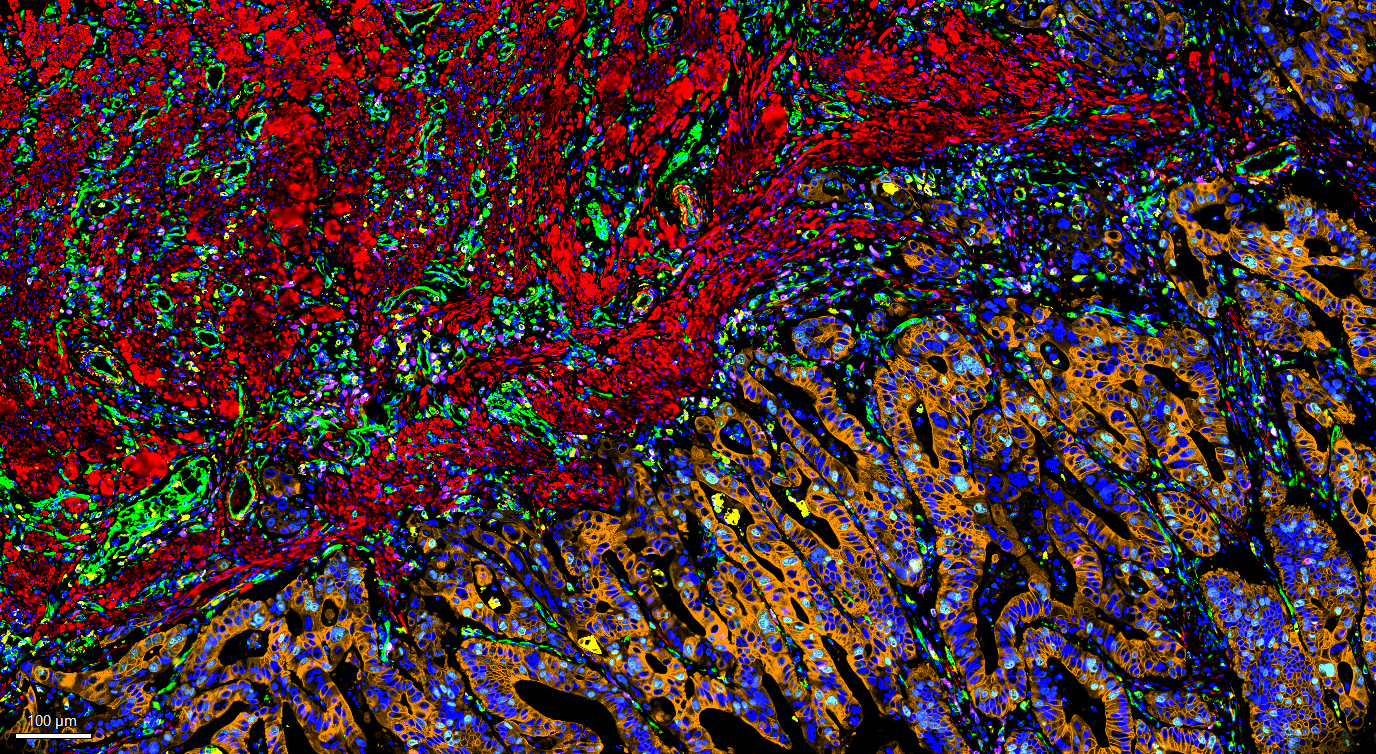 Exploration of tumor-immune landscape in colorectal adenocarcinoma using AI-powered multiplexed image analysis