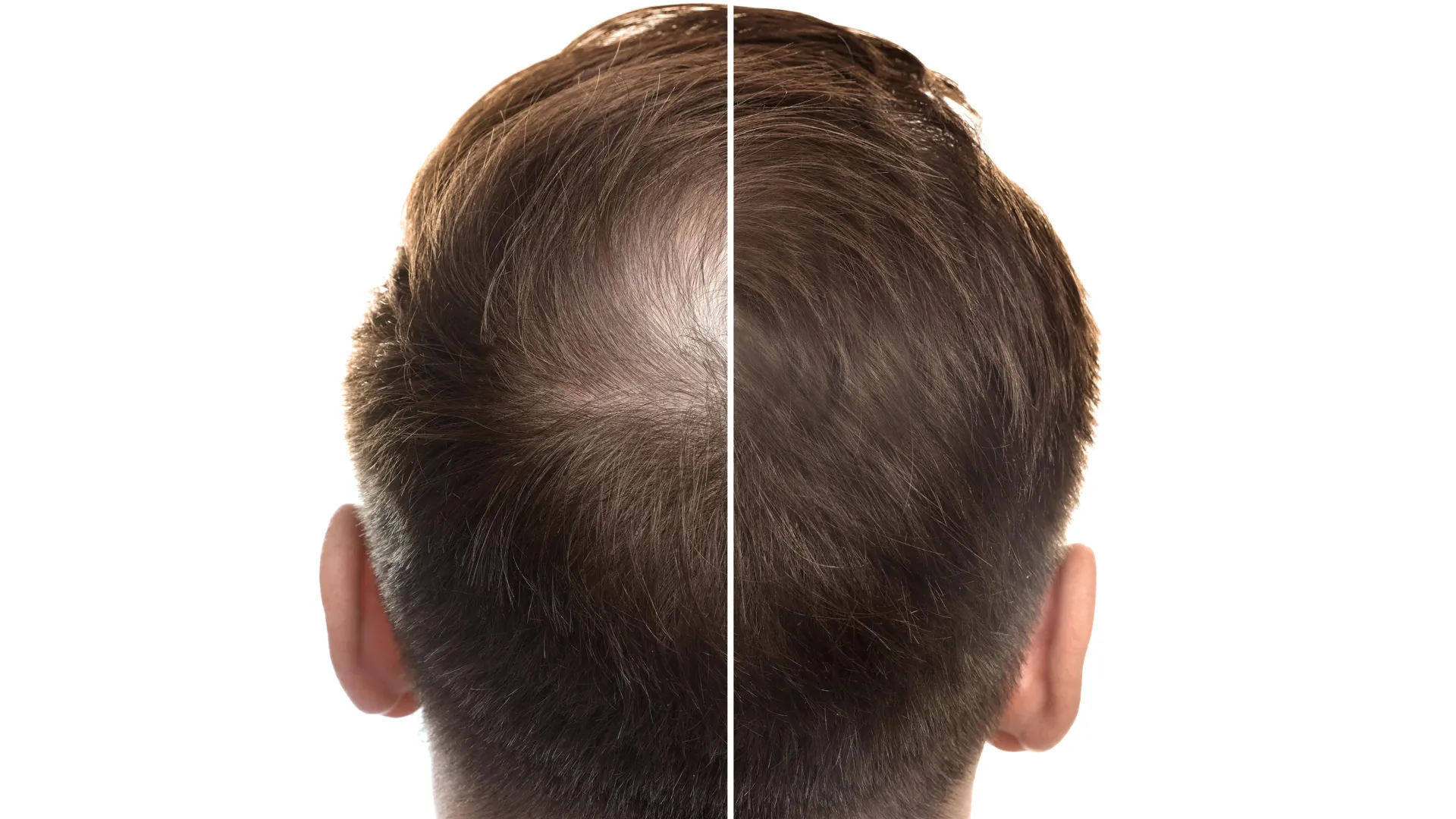 A sweet fix for baldness? Stevia compound boosts hair growth