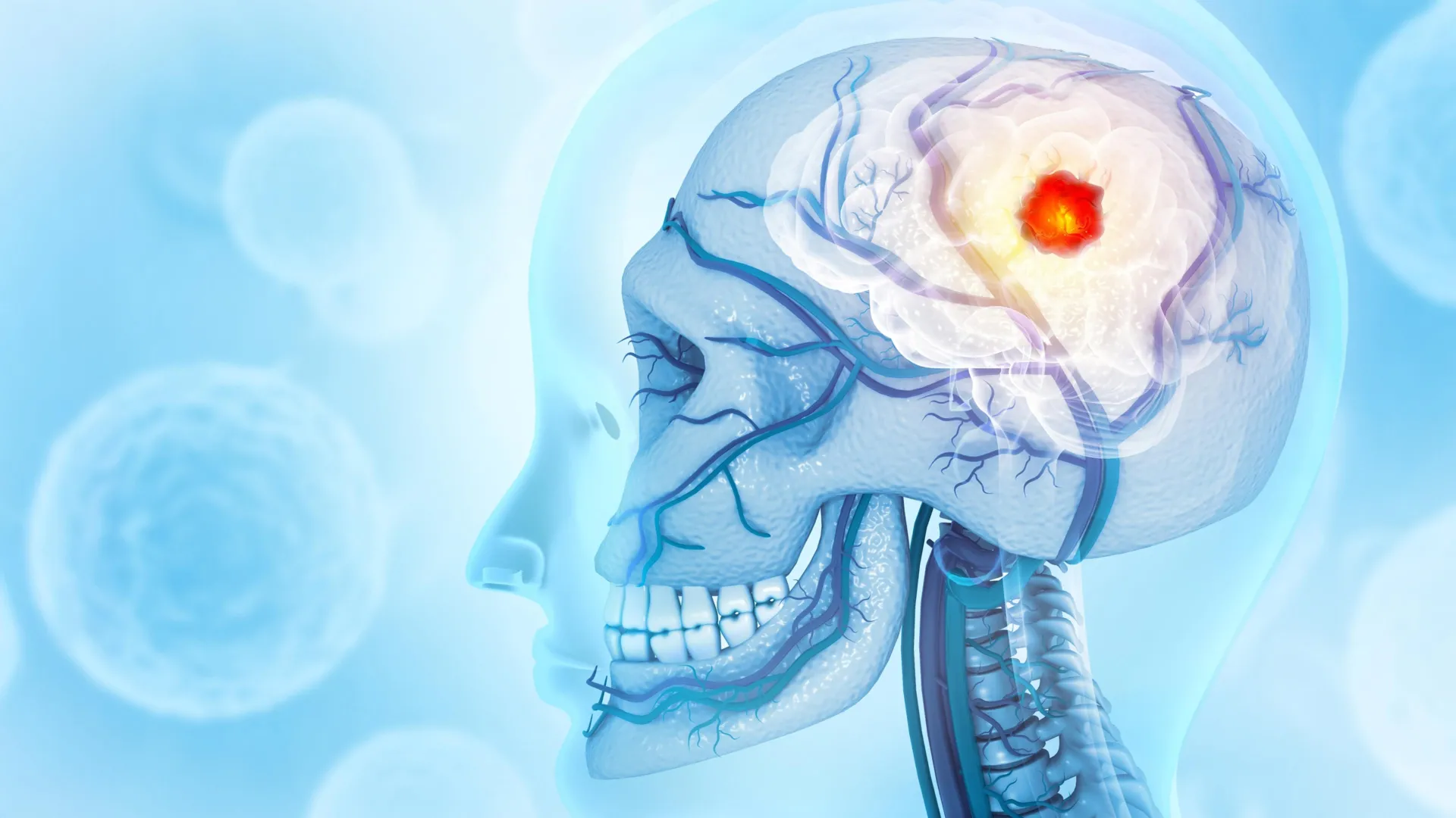 Brain cancer that eats the skull stuns scientists