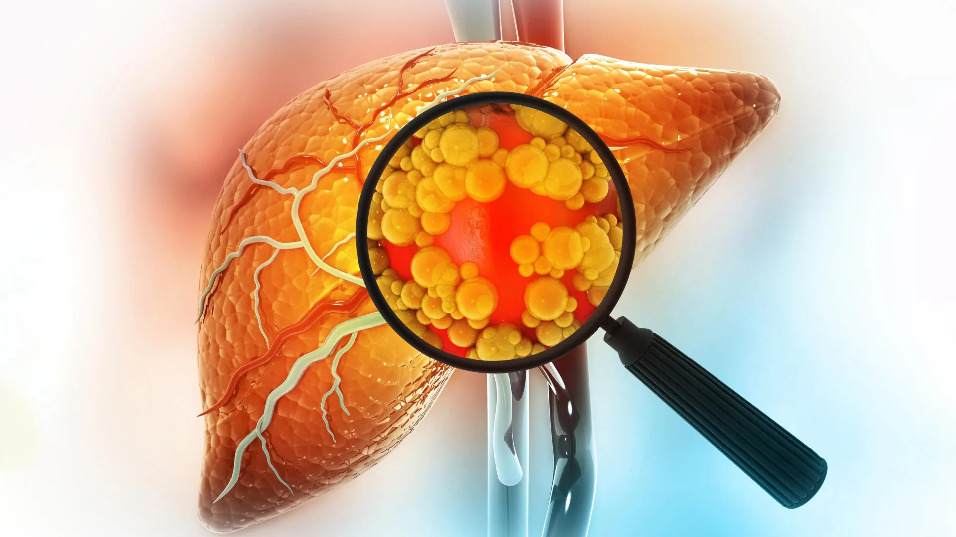 Surprising study reveals what really kills fatty liver disease patients