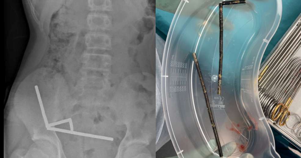Surgeons remove dozens of magnets from teen’s stomach