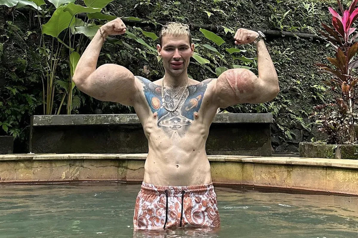 Deflated influencer denies reports of near-fatal necrosis, arm amputation