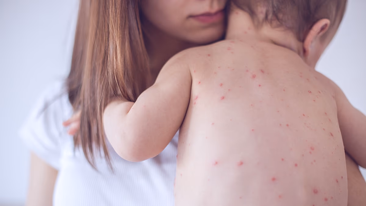 Measles cases rose 47% in Europe and Central Asia last year amid global surge in outbreaks, WHO says