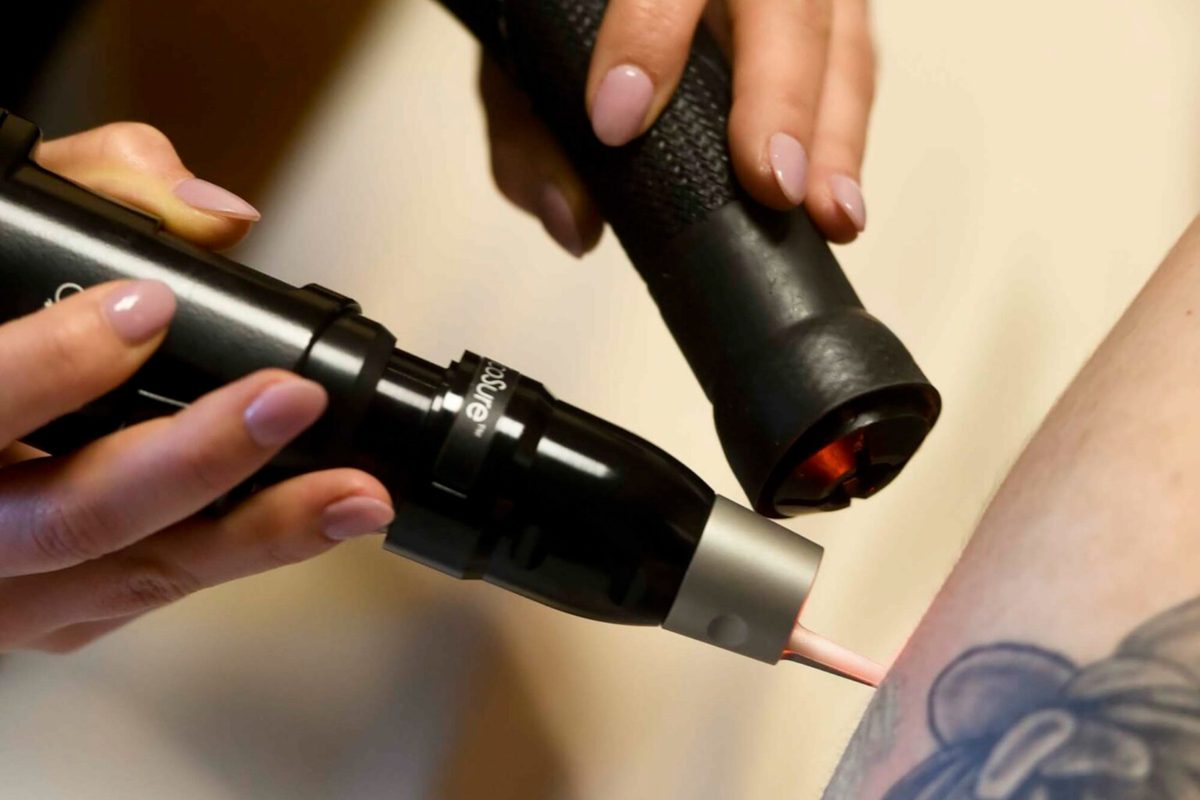 Why laser-removed tattoos mostly end up in toilets
