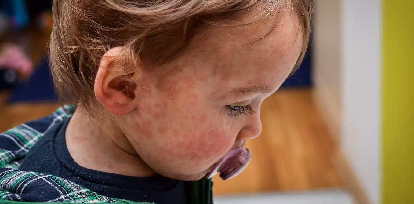 Canada loses its official ‘measles-free’ status – and the US will follow soon, as vaccination rates fall