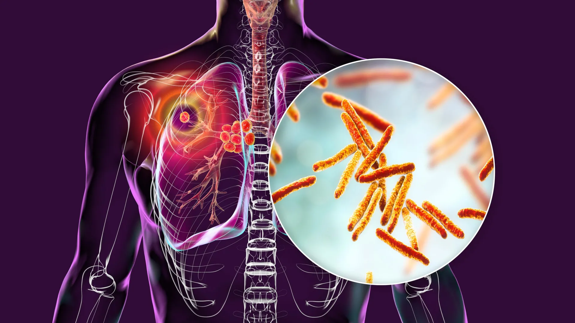 This new drug candidate might finally outsmart tuberculosis