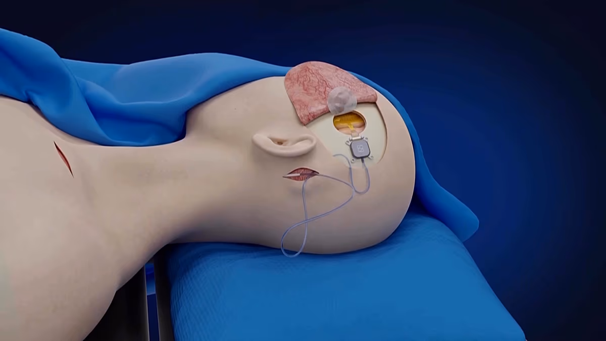 Paralysed man controls devices with his mind just five days after brain implant surgery in China