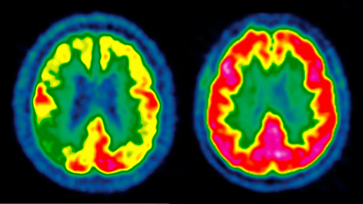 GLP-1 drugs failed to slow Alzheimer’s in two big clinical trials