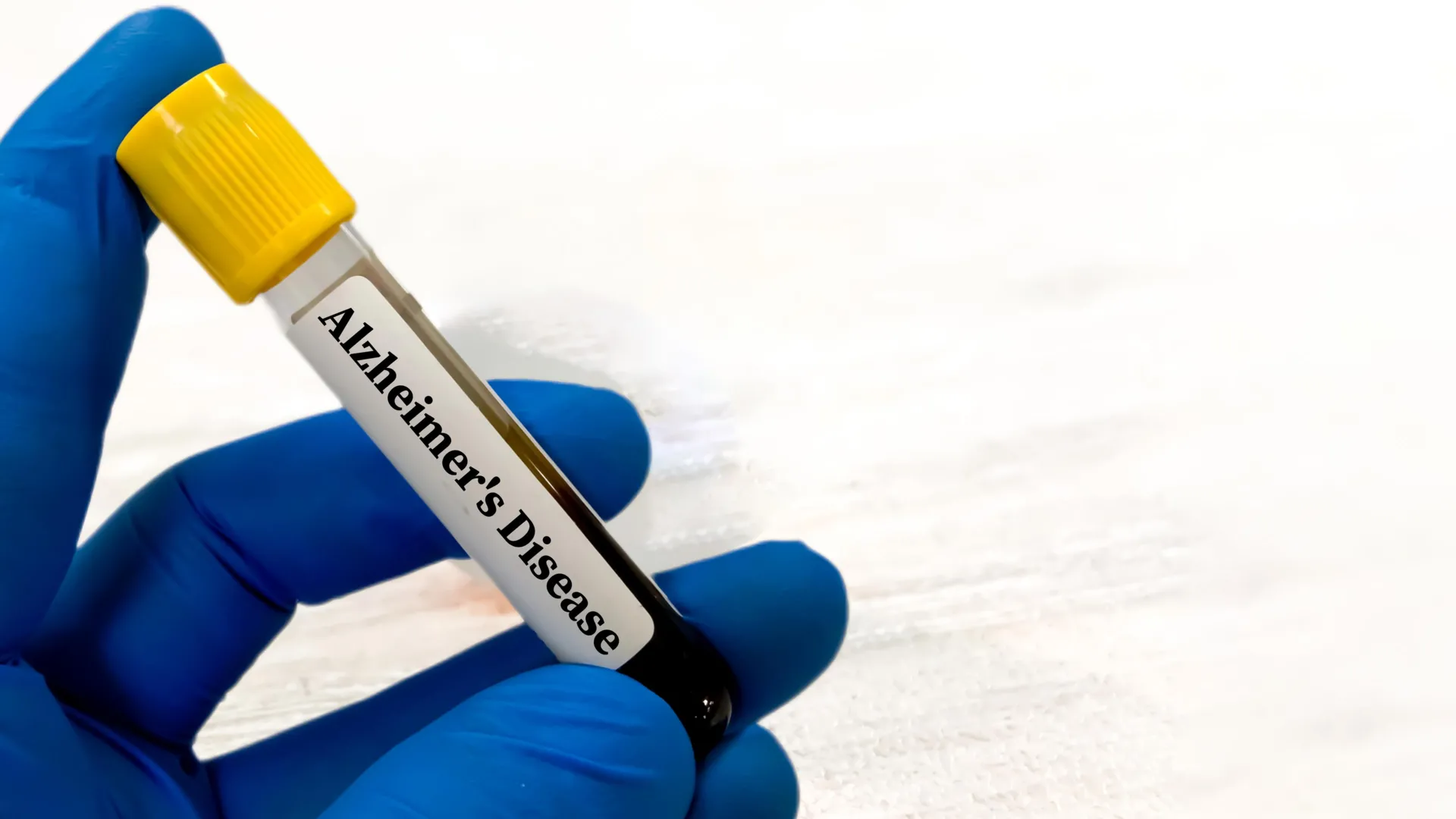 Alzheimer’s blood tests may be misleading for people with kidney problems