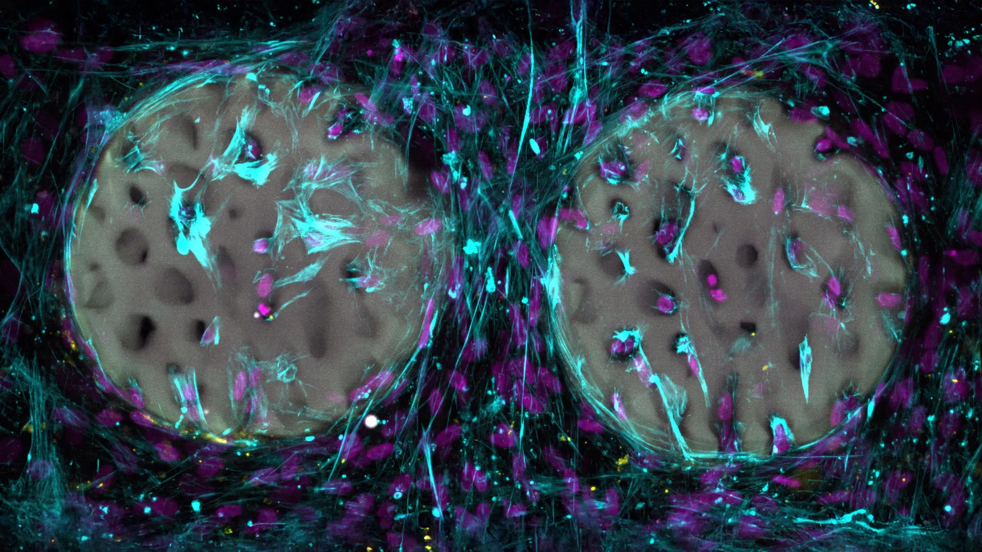 Laser printed hydrogel implant could transform bone repair