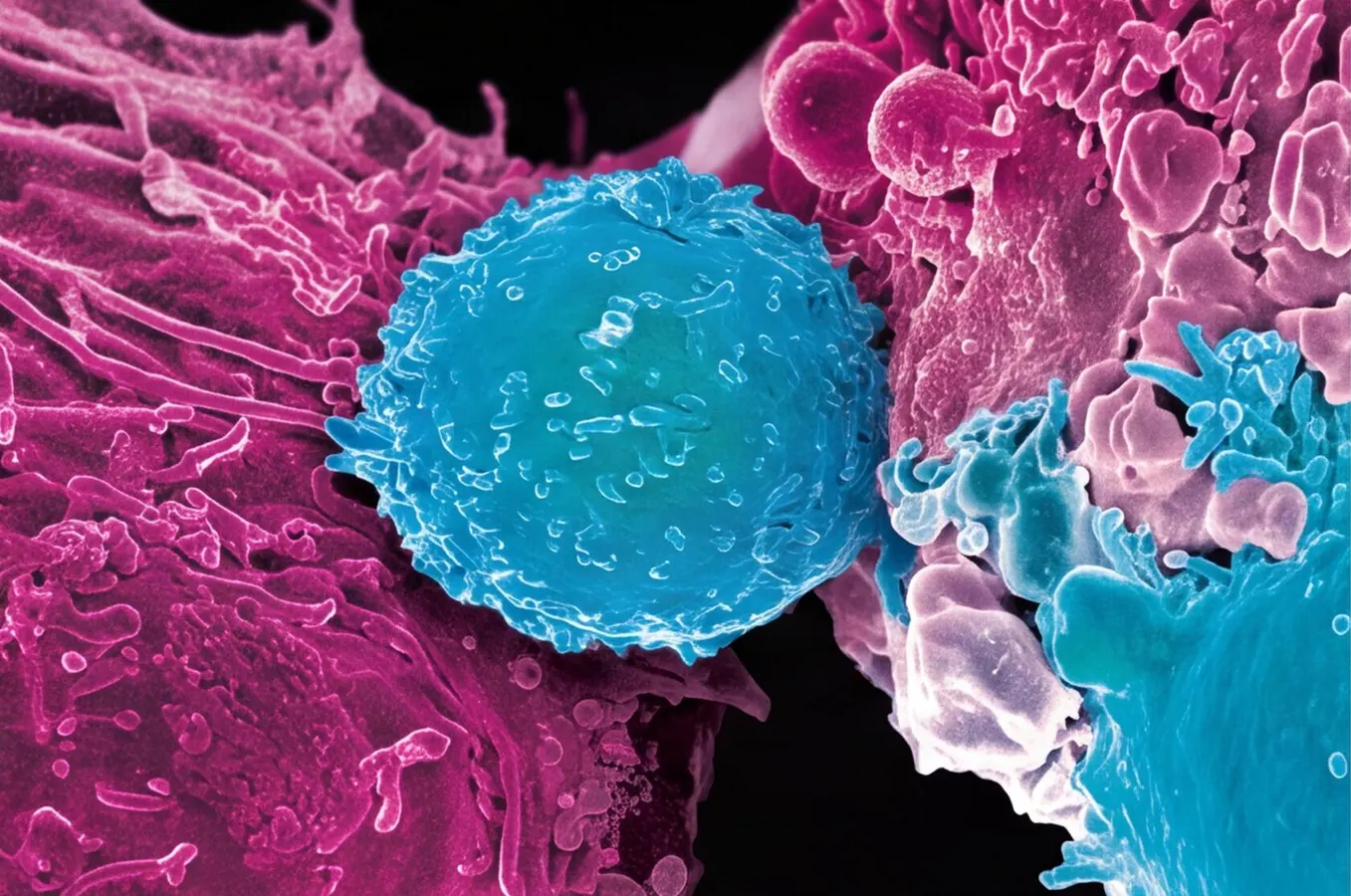 The Remarkable Success Of CAR T For Lymphoma 10 Years Later