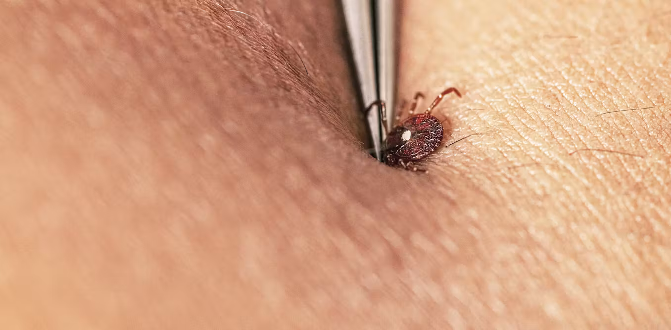 How to avoid tick bites in your yard or while hiking in the woods, and what to do if one starts feasting on you